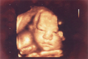 胎児エコー写真1