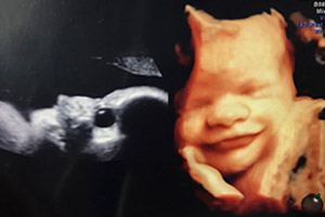 胎児エコー写真2